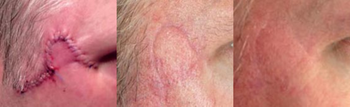 Facial Scar case 1