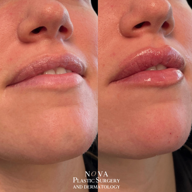 before and after lip fillers
