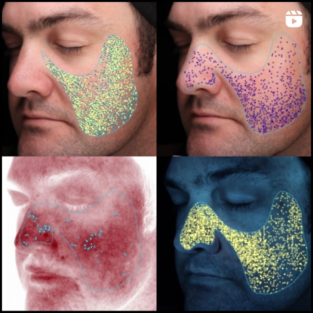 four photo diagram of a mans facial areas
