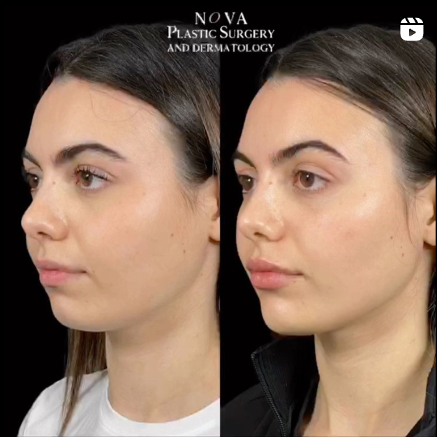 before and after photo of a young female patient