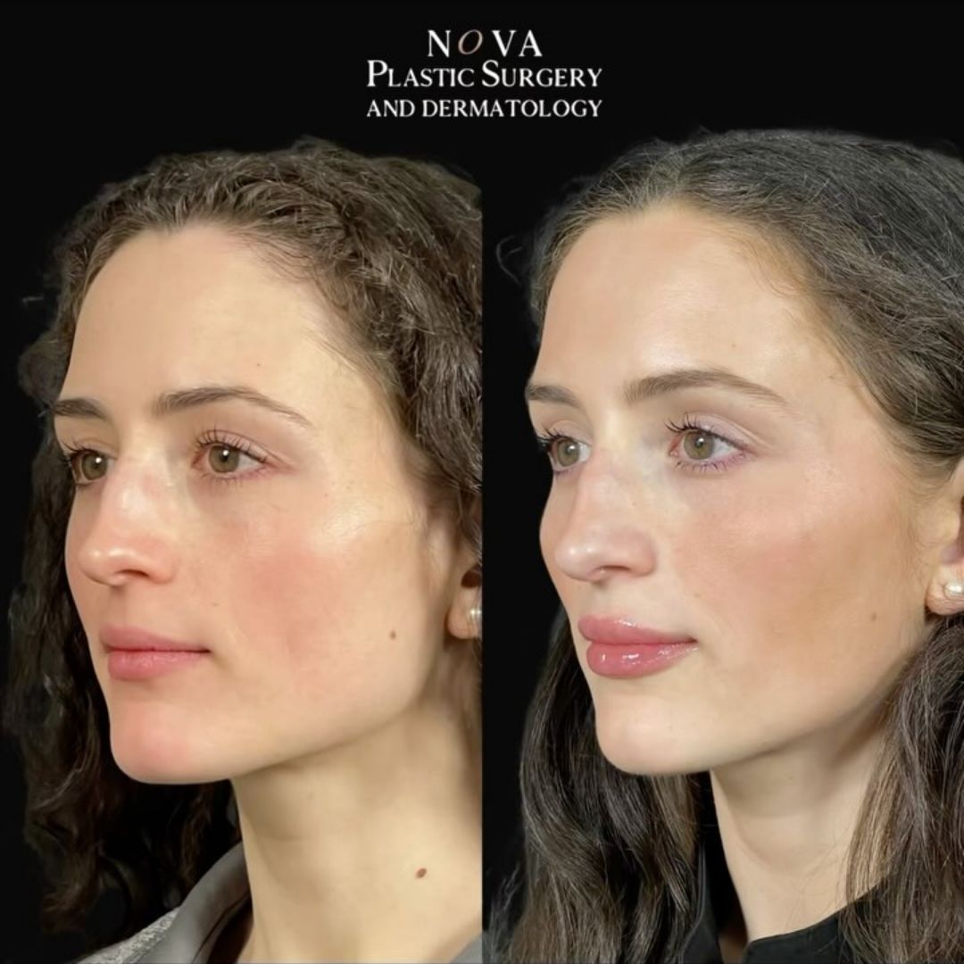before and after lip filler