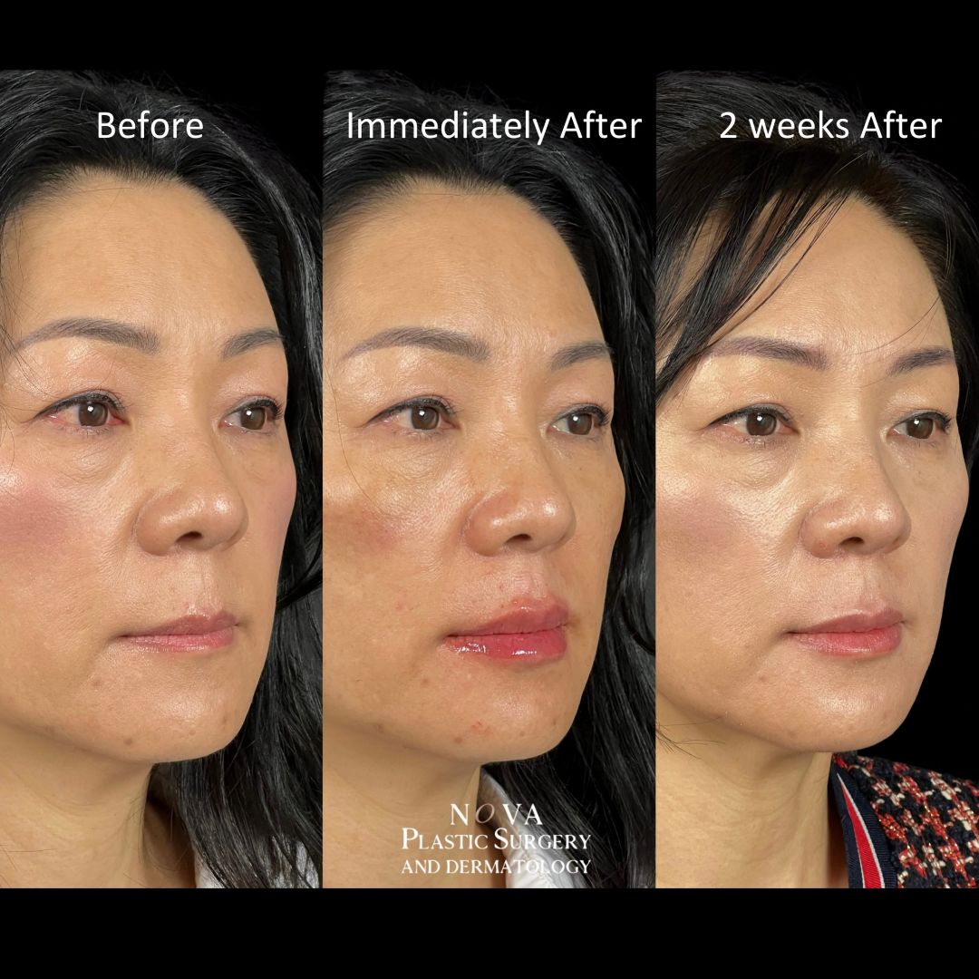 restylane kysse - lip filler before and after