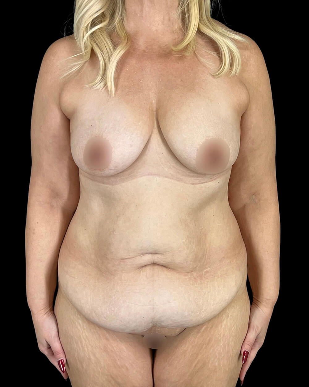 Case--2208 | Before Fadi Nukta, MD FACS
