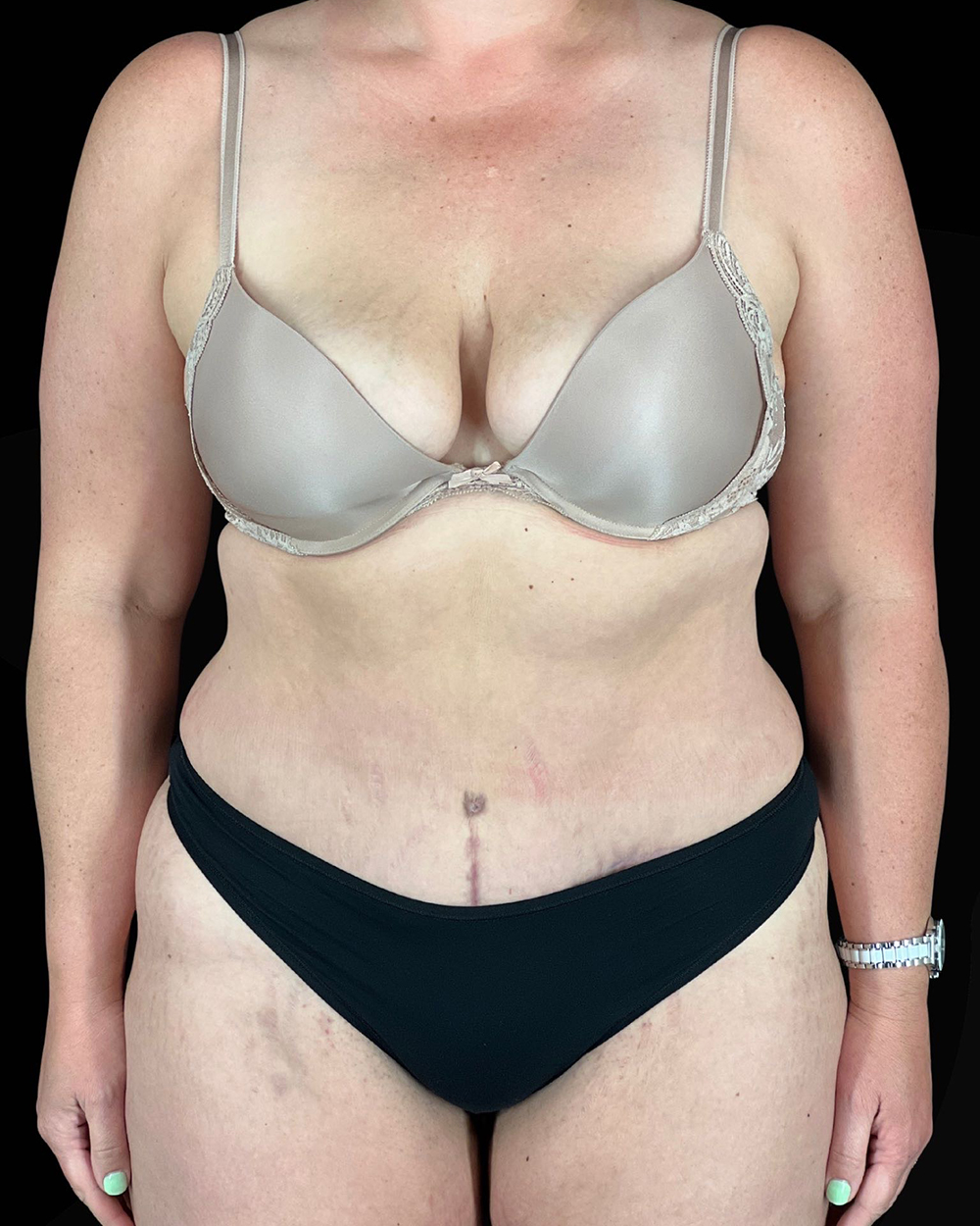Case--9283 | After Fadi Nukta, MD FACS