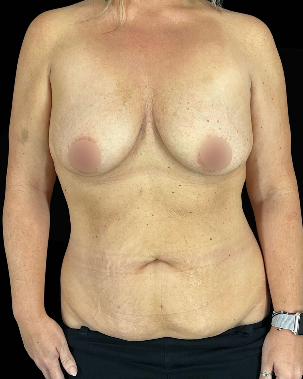 Case--8427 | Before Body