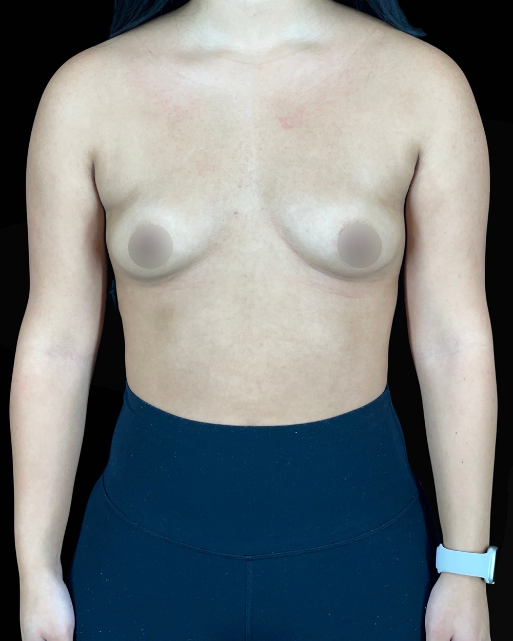 Case--8015 | Before Breast Augmentation 1