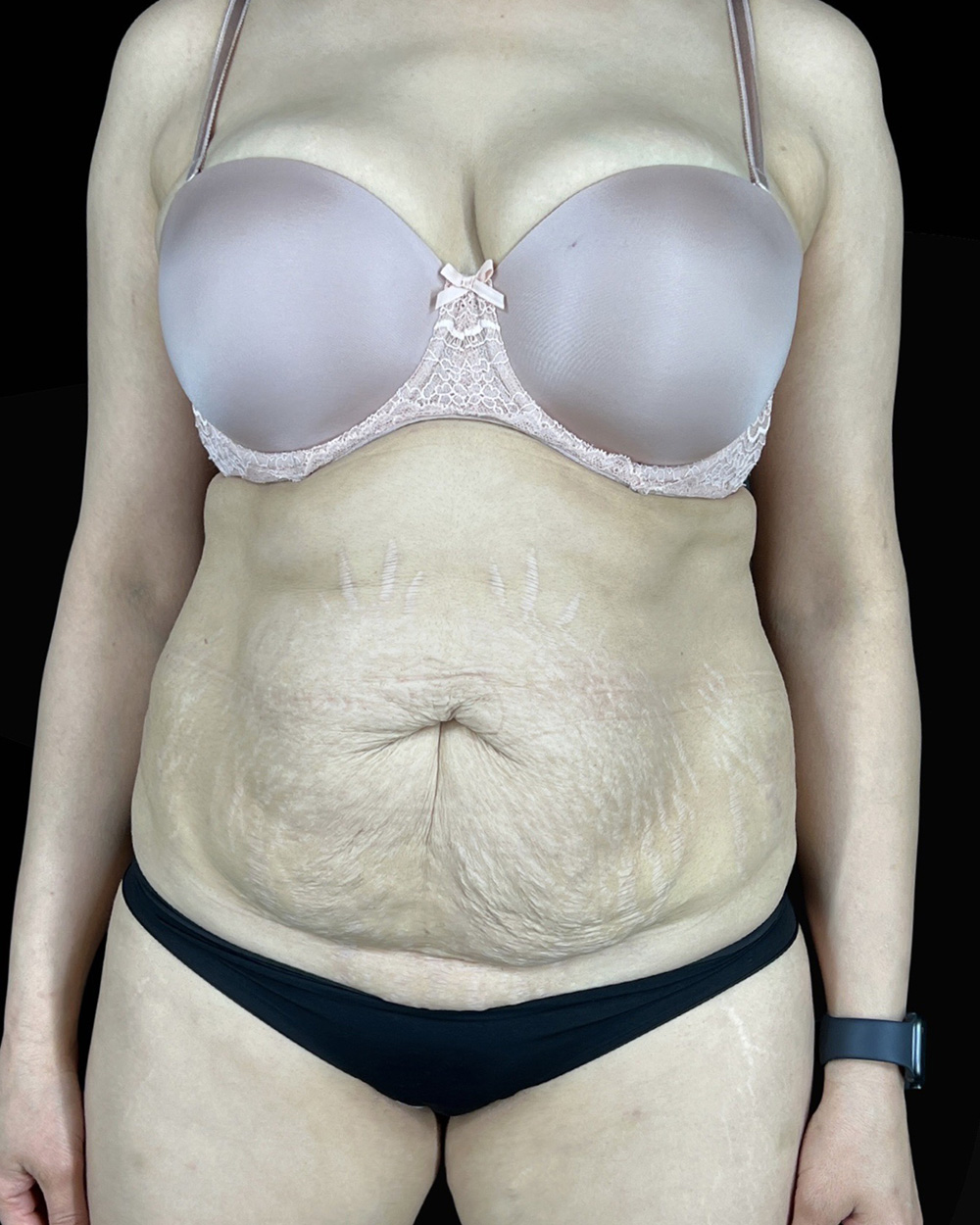 Case--5405 | Before Body