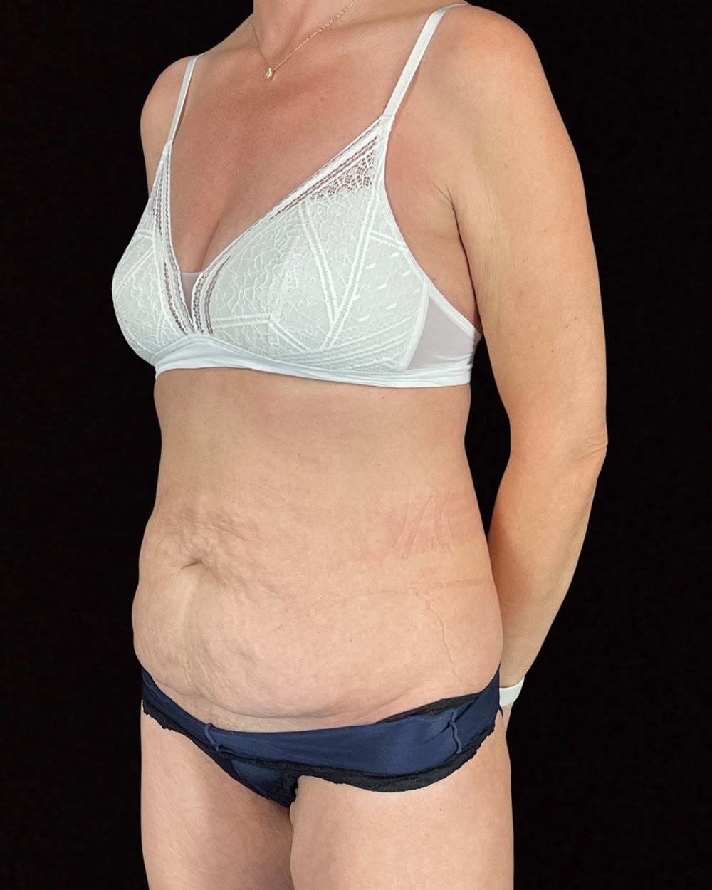 Case--4857 | Before Body