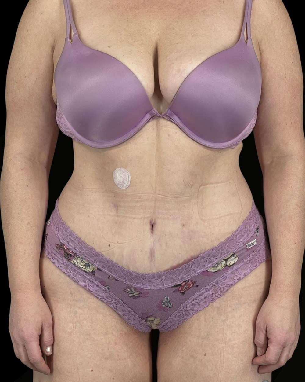 Case--4470 | After Fadi Nukta, MD FACS