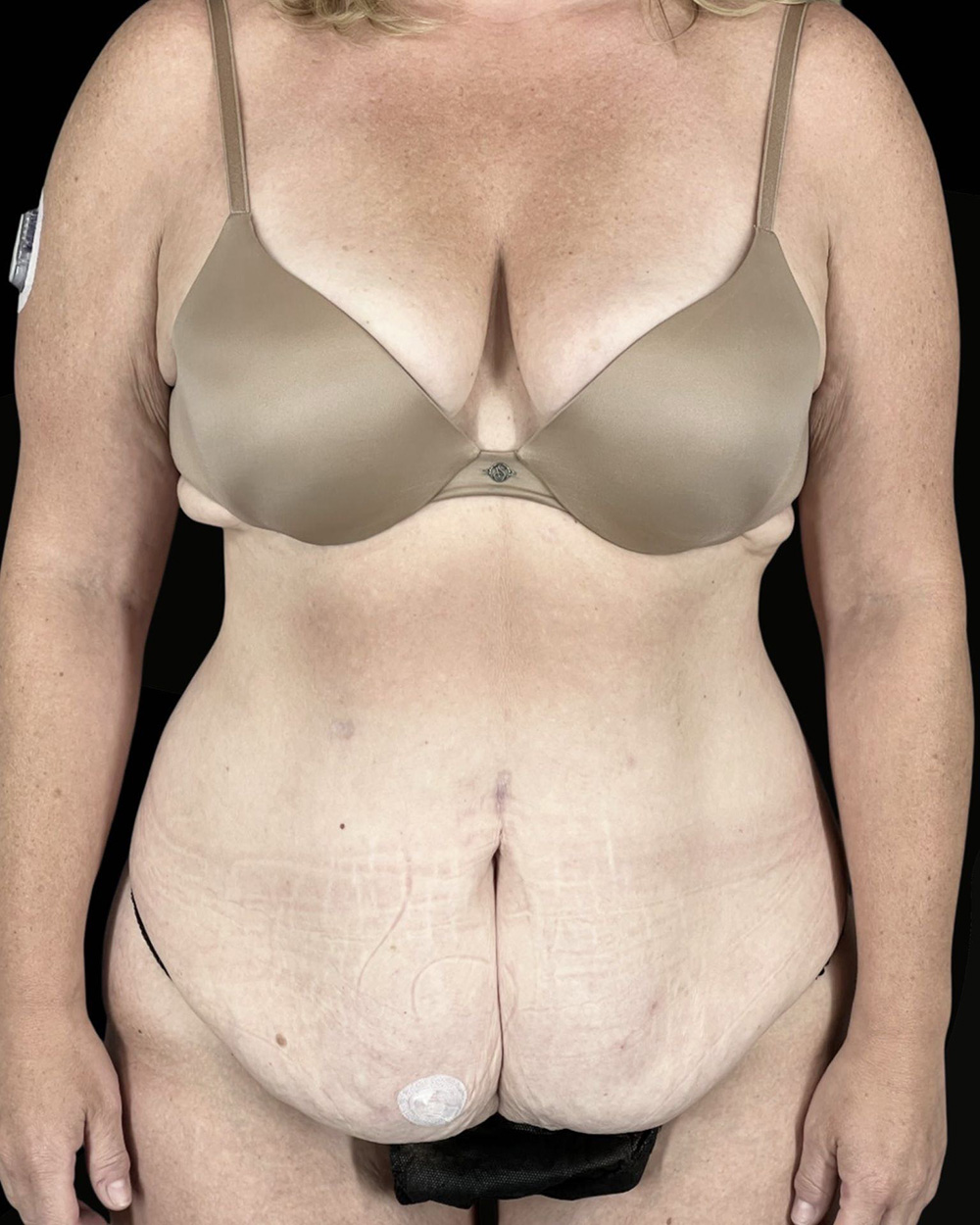 Case--4470 | Before Fadi Nukta, MD FACS