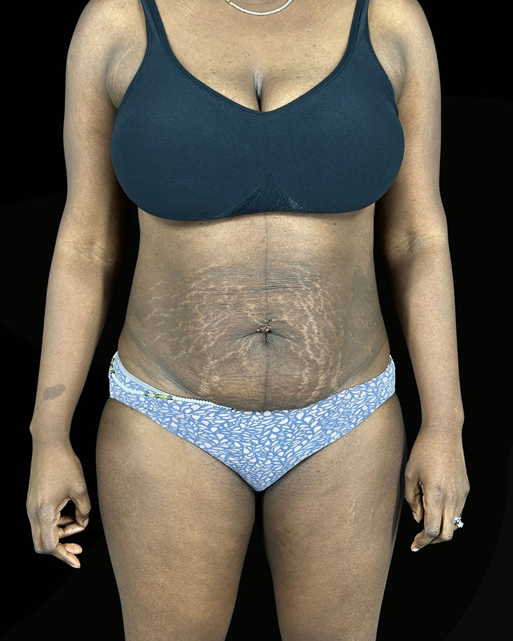 Case--6142 | Before Body