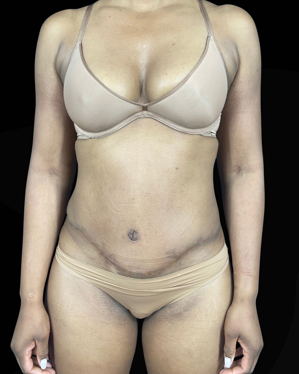 Case--1644 | After Body