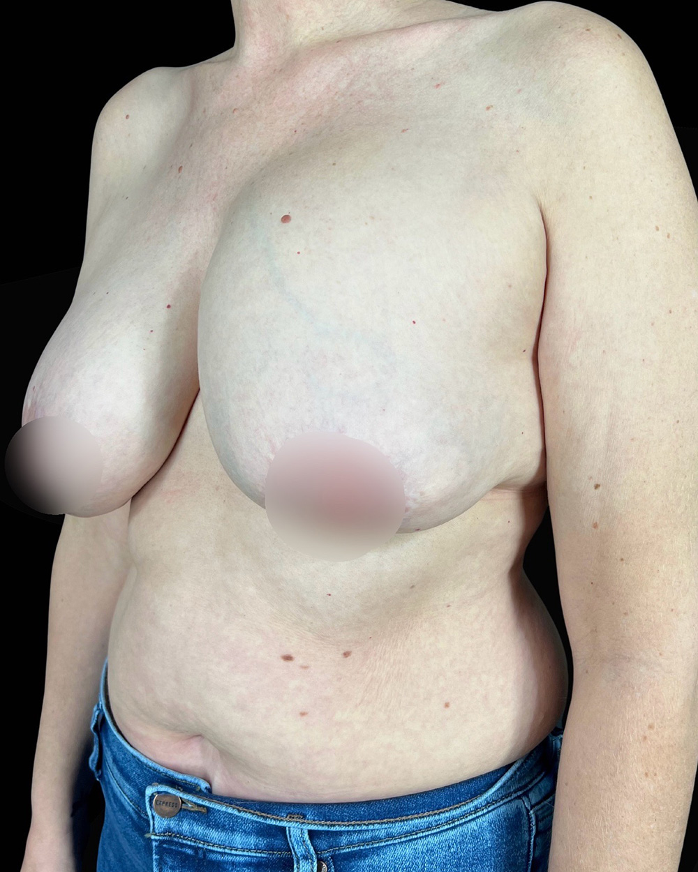 Case--6558 | Before Breast Augmentation/Lift 1
