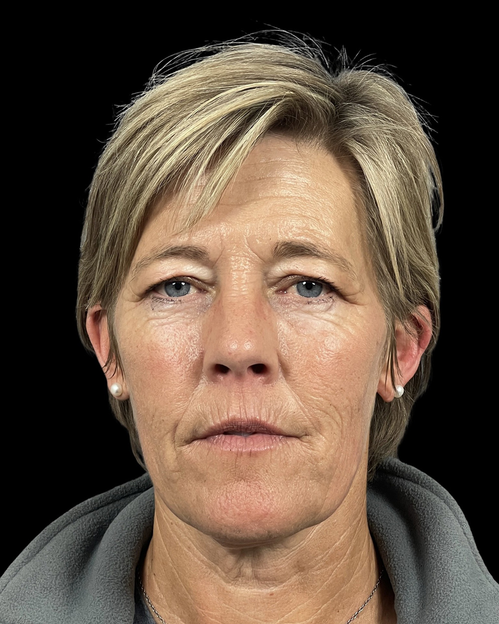 Case--8839 | Before Face