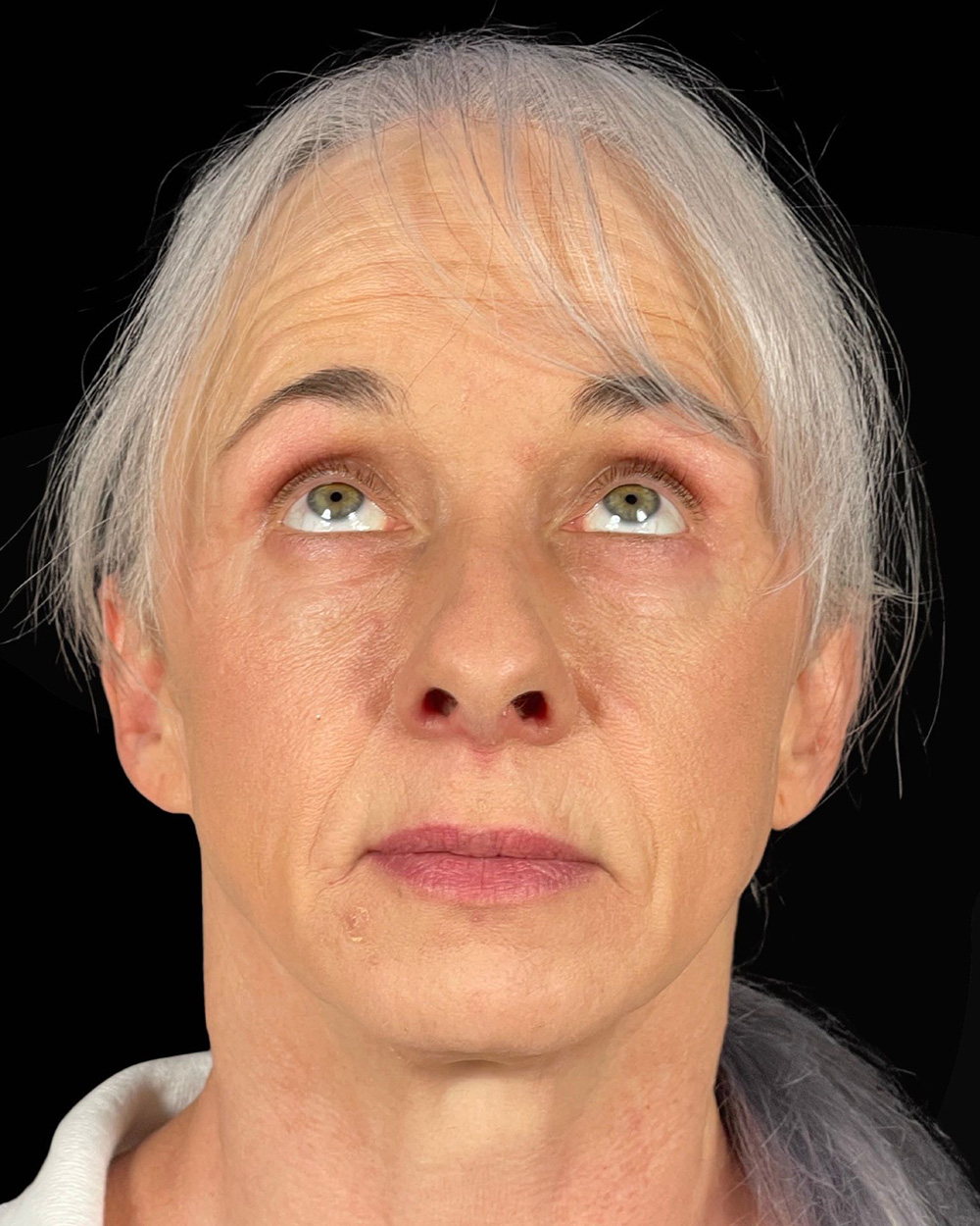 Case--7507 | After Blepharoplasty 2