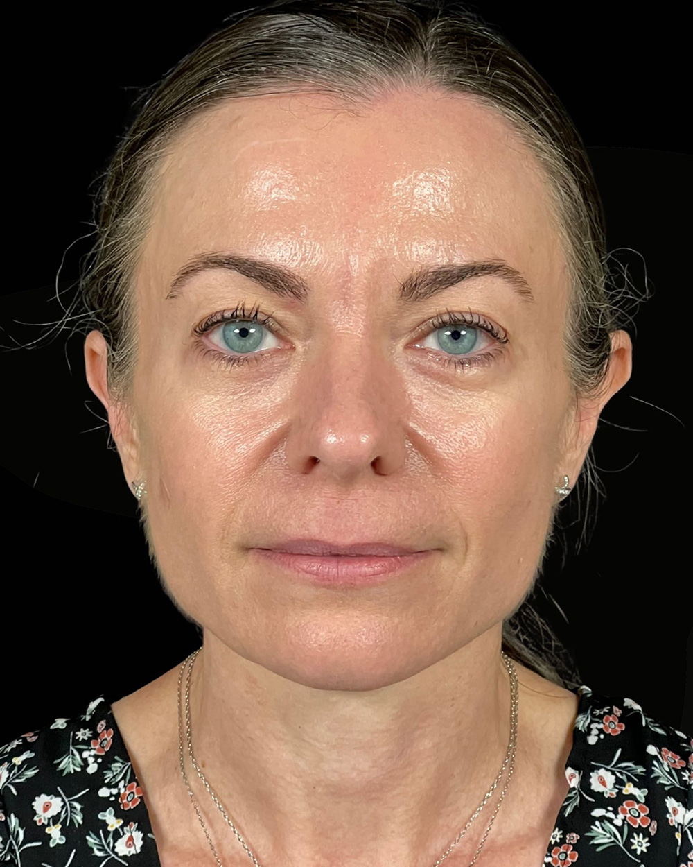 Case--9596 | Before Face