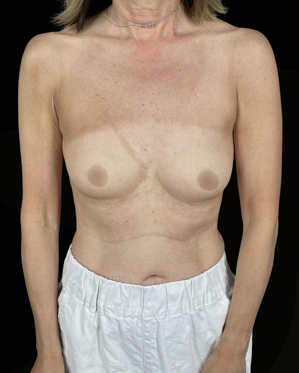 Case--2539 | Before Breast Augmentation