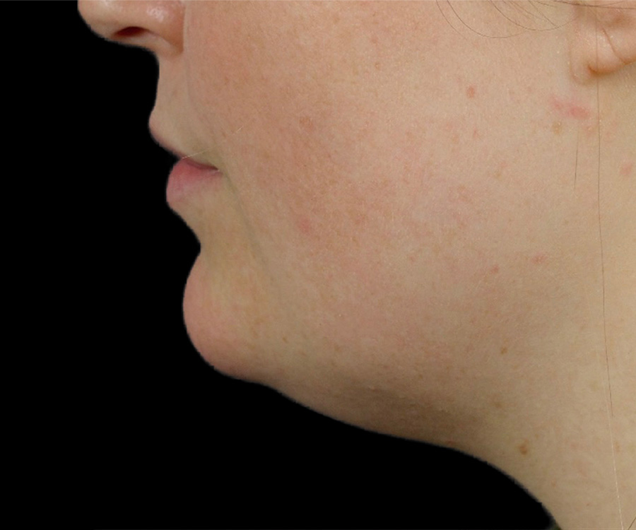 Case--5898 | Before Face