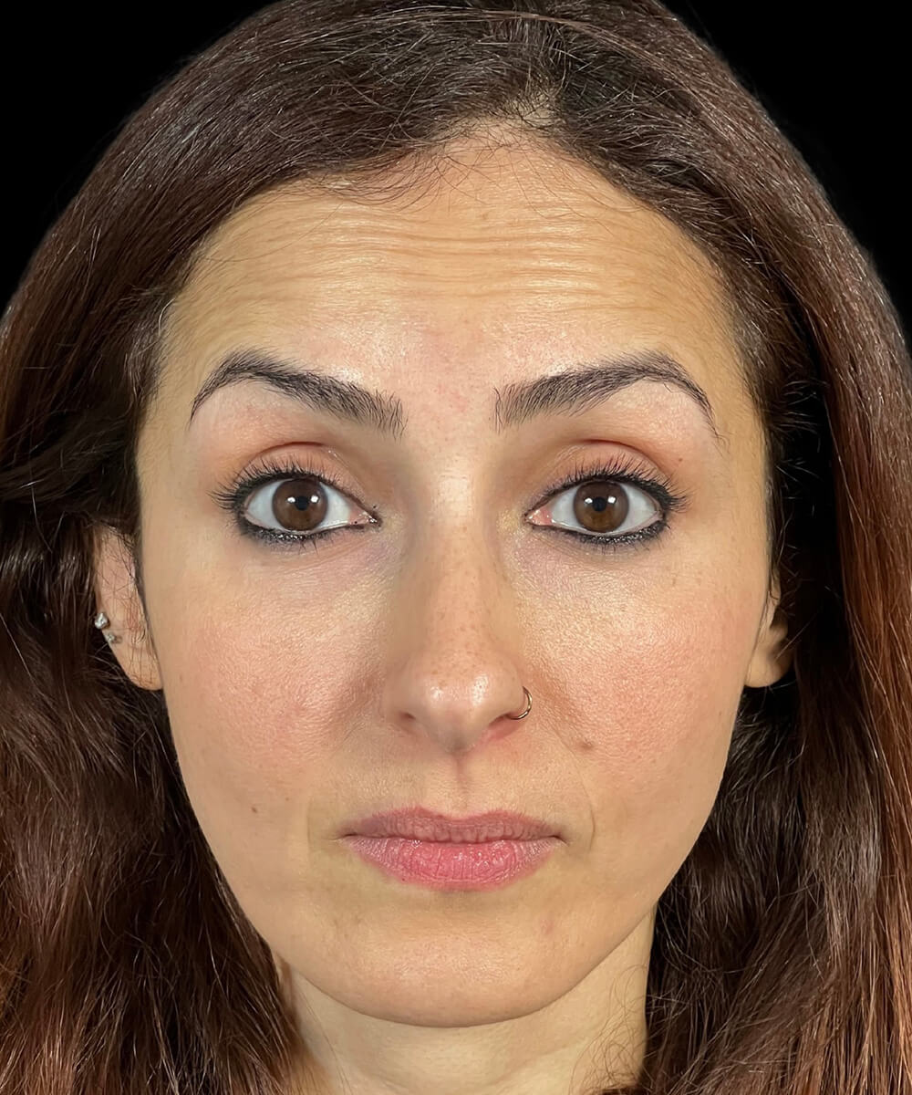 Case--4565 | Before Non-Surgical