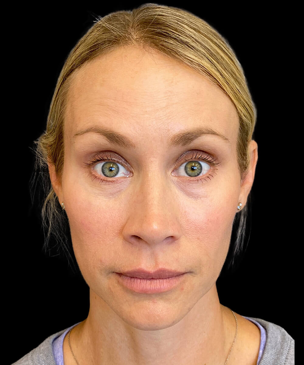Case--9145 | After Non-Surgical
