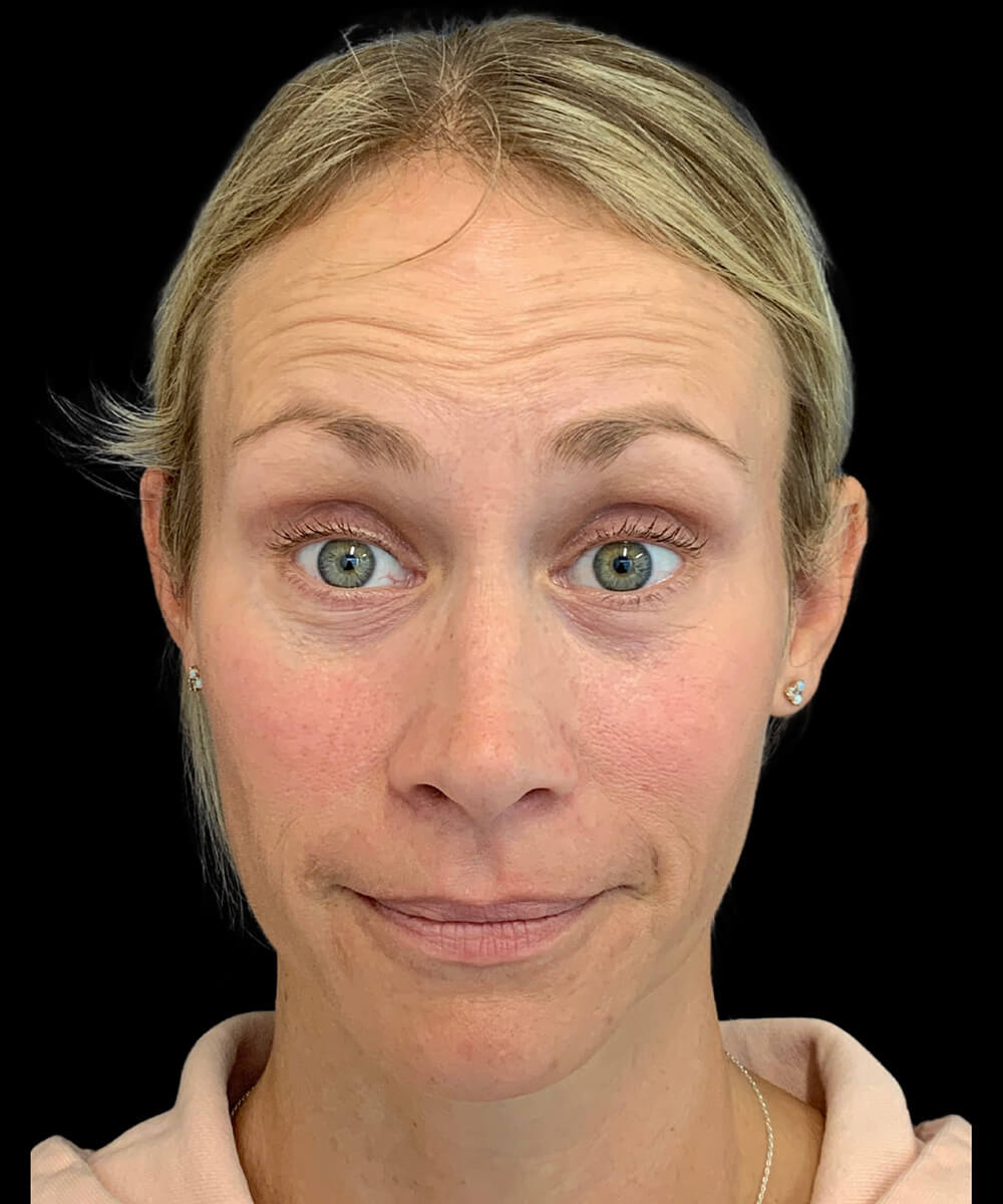 Case--9145 | Before Non-Surgical