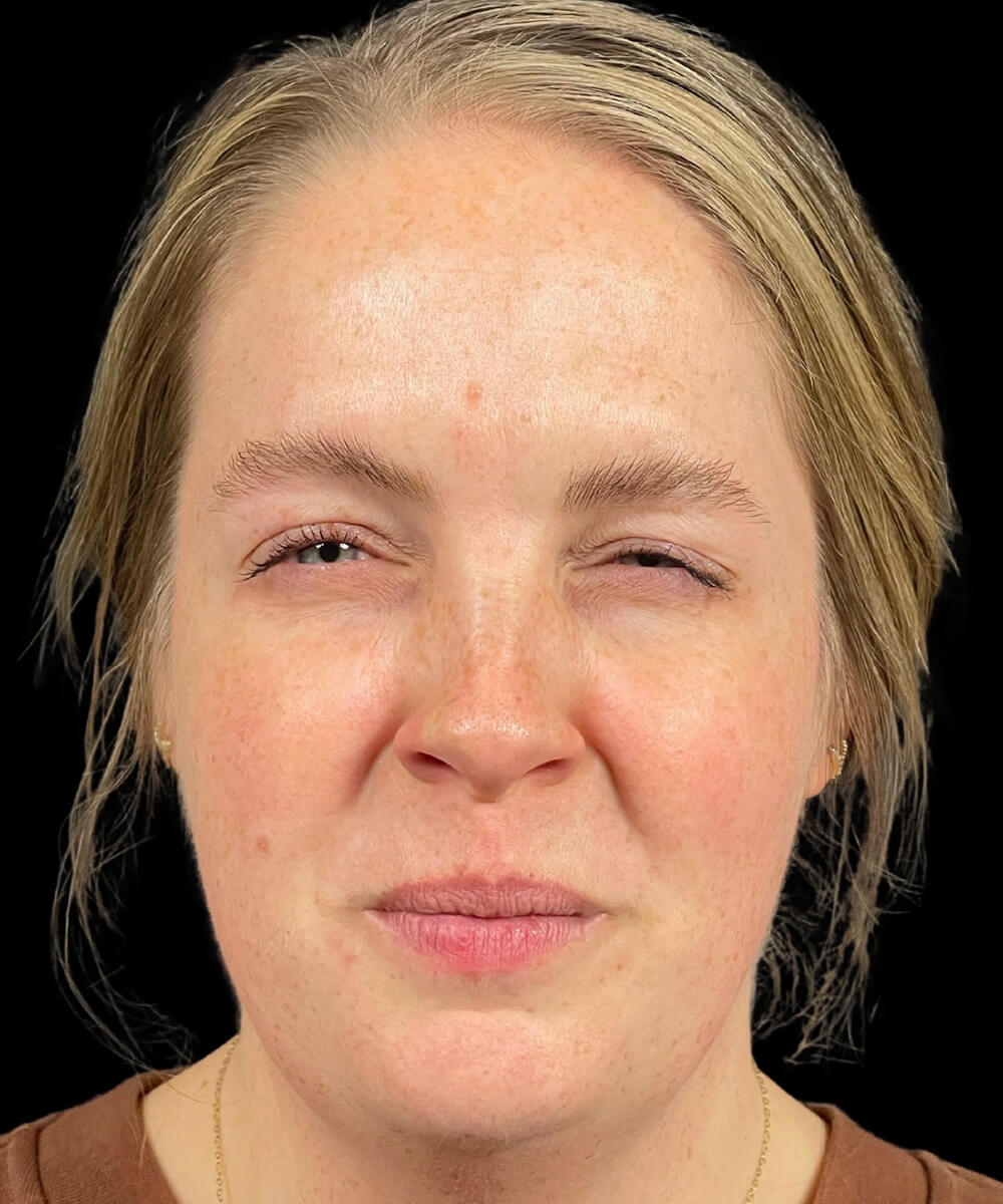Case--6683 | After Non-Surgical