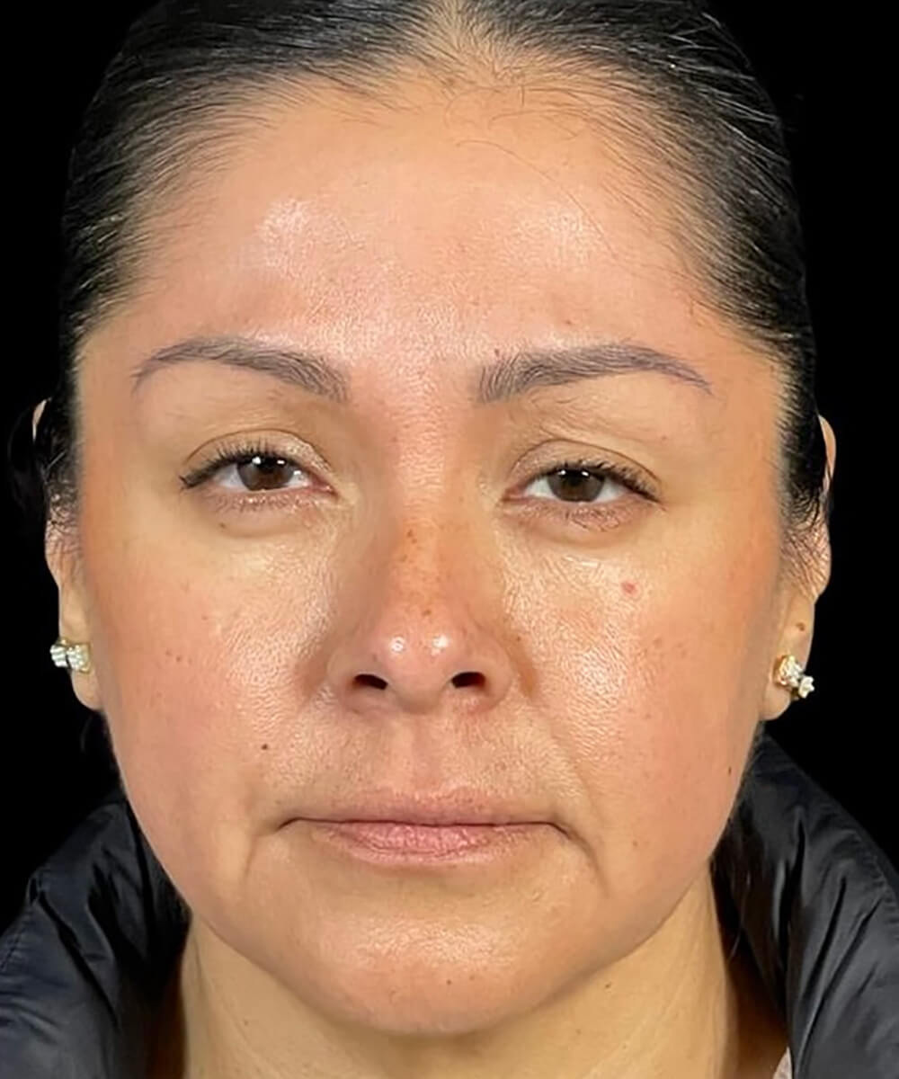 Case--8171 | After Non-Surgical