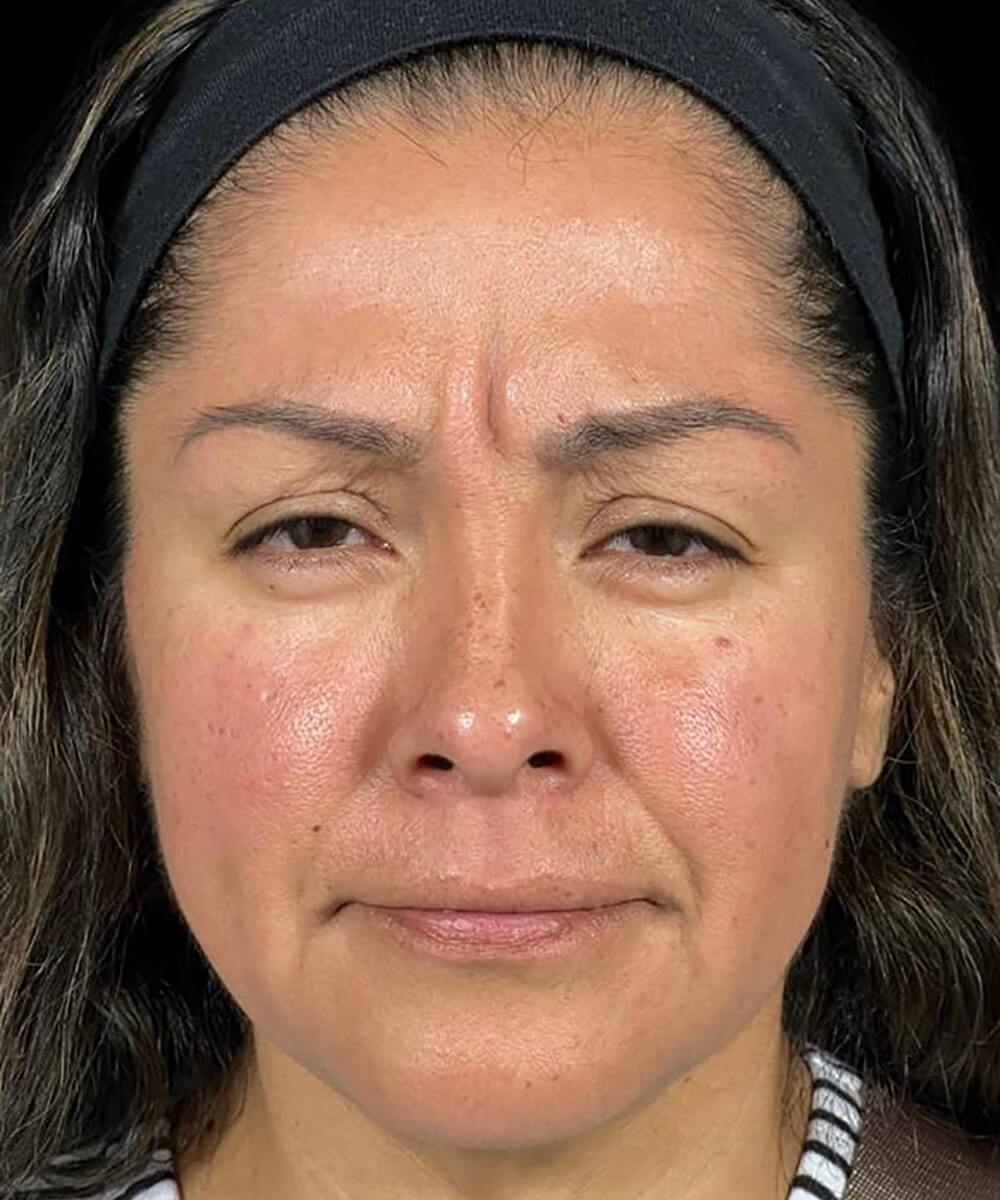 Case--8171 | Before Non-Surgical