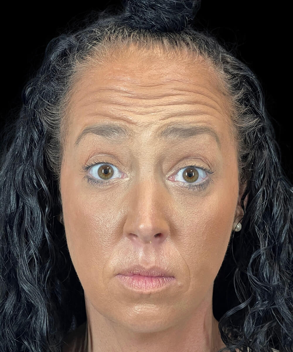 Case--5386 | Before Non-Surgical